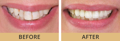 Englewood OH cosmetic dentistry patient before and after photos