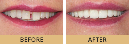 Dayton OH cosmetic dentistry patient before and after photos