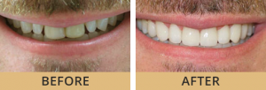 A before and after side-by-side image of cosmetic dentistry results.