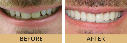 Englewood OH cosmetic dentistal patient at Vitangeli Dental before and after photos