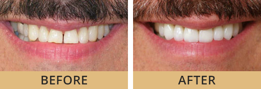 Dayton OH cosmetic dentistal patient at Vitangeli Dental before and after photos