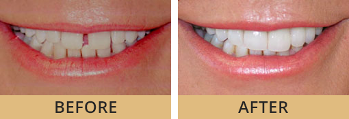 Brookville OH cosmetic dentistal patient at Vitangeli Dental before and after photos