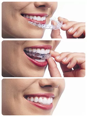 Invisalign Invisible Braces in Dayton and Brookville