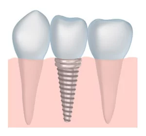 Dental Implants Dentistry in Dayton and Brookville