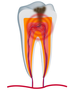 Root Canals, Toothache, endondontics for Dayton and Brookville