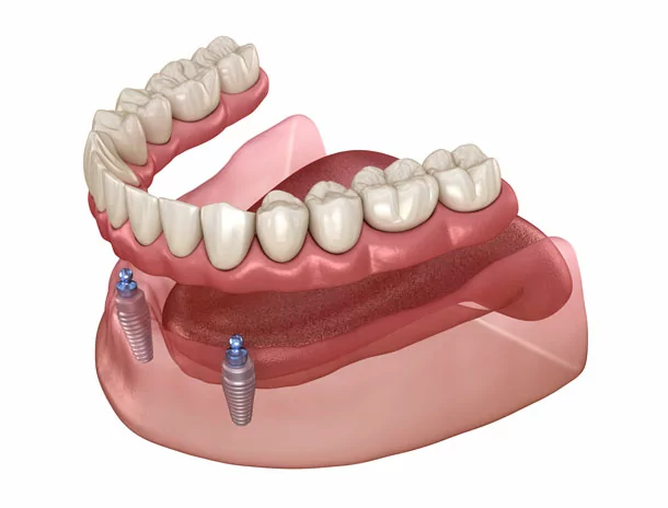 Removable implant supported dentures in Englewood by Dr. Vitangeli