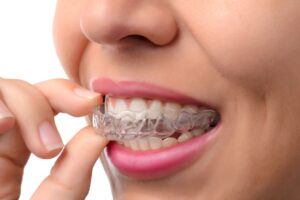A young woman inserting a clear aligner for straighter teeth.