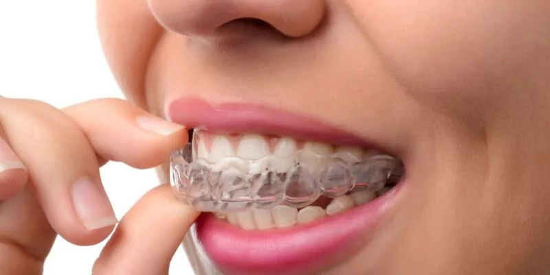 A young woman inserting a clear aligner for straighter teeth.