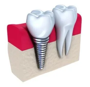 A graphic image of a dental implant in a jawbone.