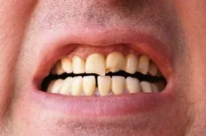 A man with chipped and cracked teeth.