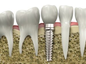 A graphic image of a dental image a tooth embedded in a jawbone for bone preservation.