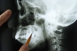 An image of a jawbone X-ray being examined.
