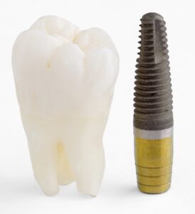 A lost tooth and a dental implant in Englewood.